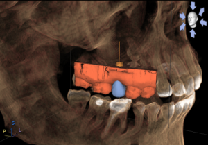 implant-dentistry-300x209