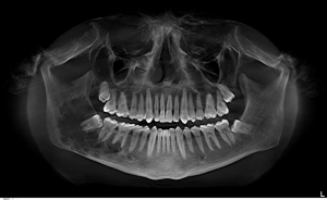 tooth-extraction-300x184