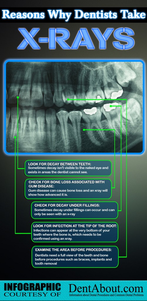 why-dentists-take-xrays-500x1024